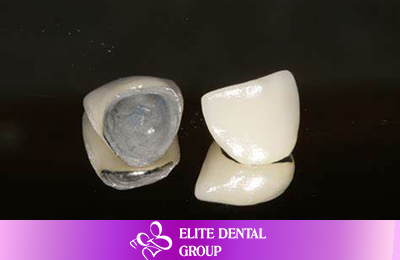 Vì sao răng sứ titan thẩm mỹ được phổ biến?
