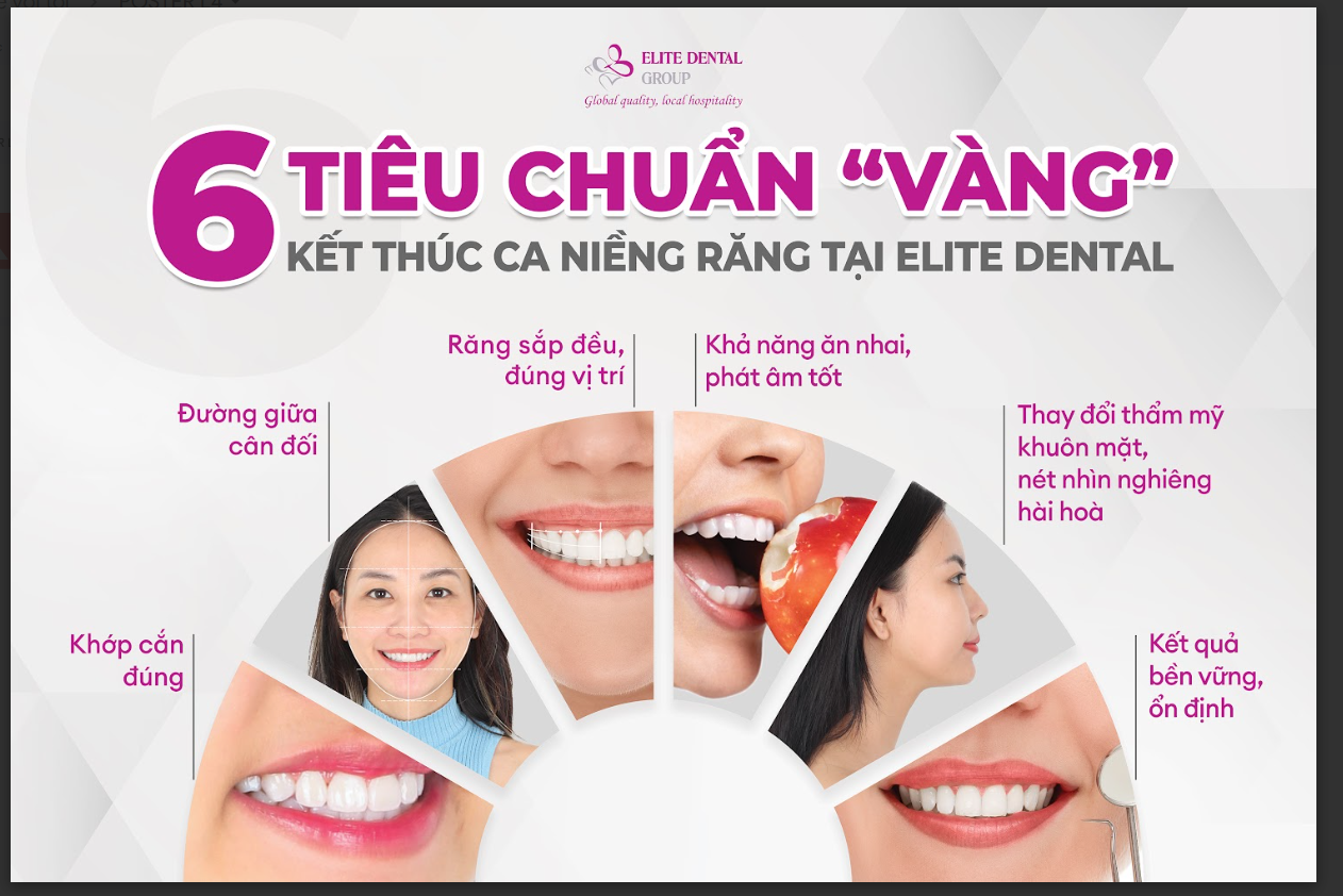6 tiêu chuẩn vàng kết thúc ca niềng răng tại Elite Dental