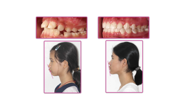 Hình ảnh khách hàng trước và sau khi niềng răng hô hàm tại Elite Dental