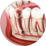  Điều trị tuỷ răng sâu - Tìm hiểu về vị trí đặc biệt trong hàm răng