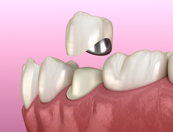5 vật liệu bọc răng phổ biến hiện nay nên chọn loại nào phù hợp   nhakhoathuyanh