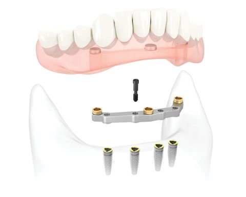 hàm phủ trên implant 2