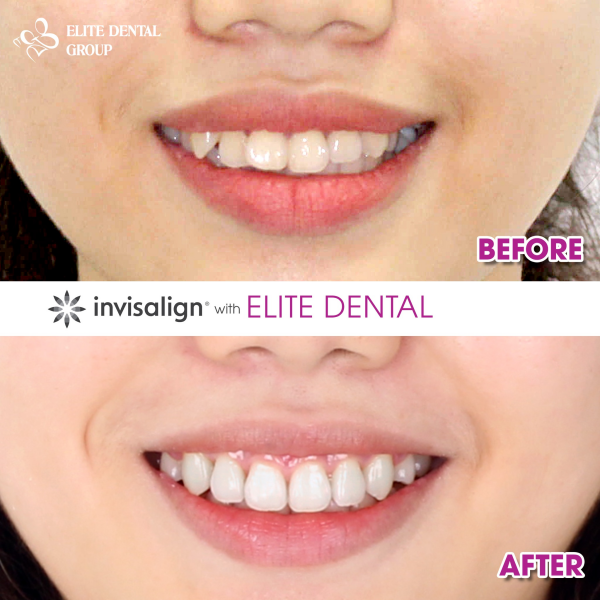 Trước và sau khi niềng răng Invisalign