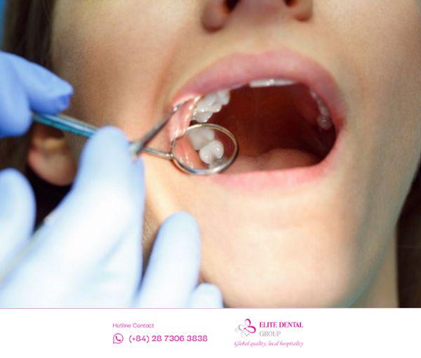 Tuân thủ hướng dẫn của bác sĩ sau khi nhổ răng khôn.