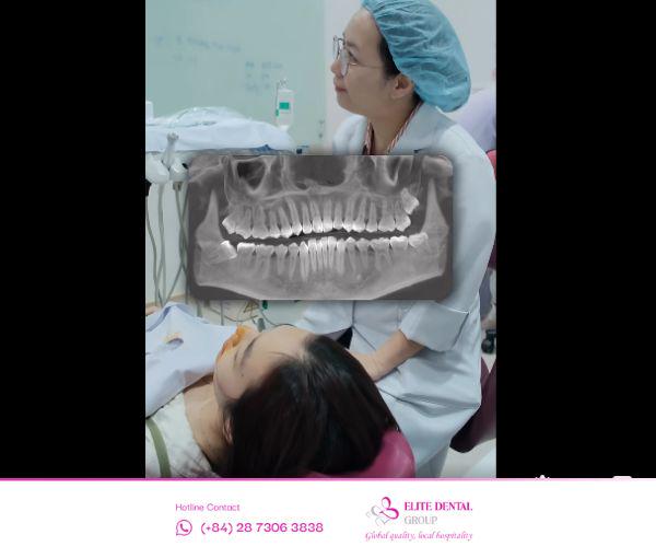 Elite Dental cung cấp dịch vụ nhổ răng khôn với công nghệ hiện đại, bác sĩ tận tâm.