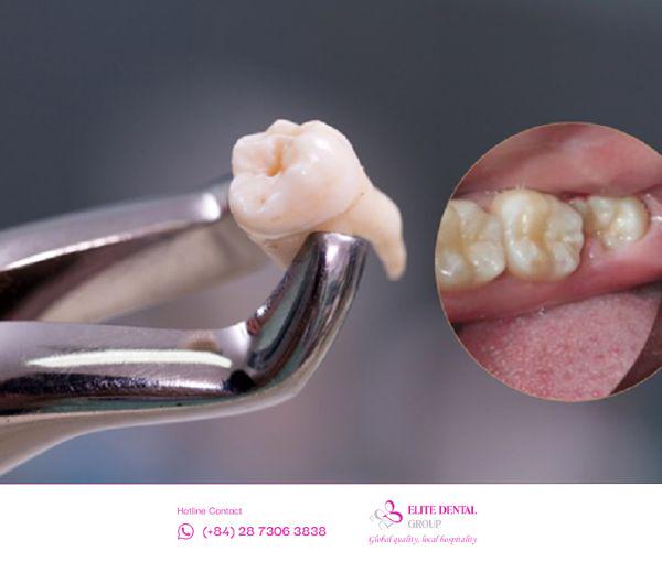 Tìm hiểu về nhổ răng khôn có nguy hiểm không? Có ảnh hưởng sức khỏe?