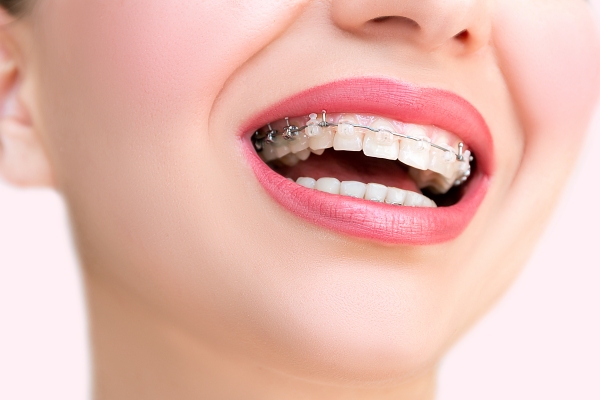 Niềng răng hô hàm trên mất bao lâu?