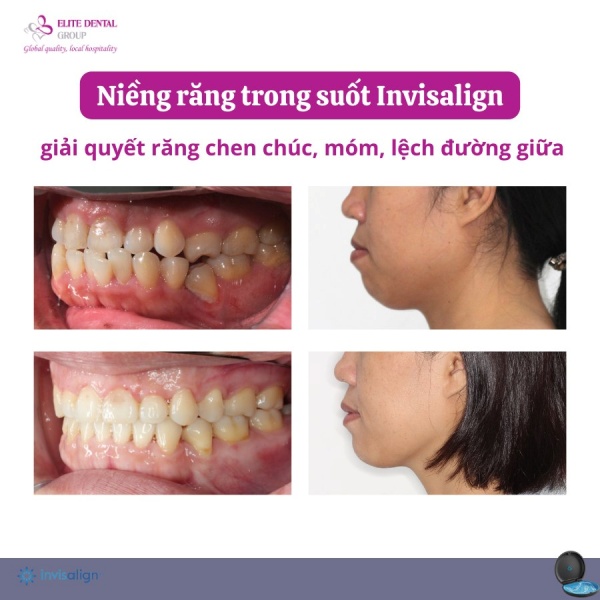 hình ảnh niềng răng móm trước và sau