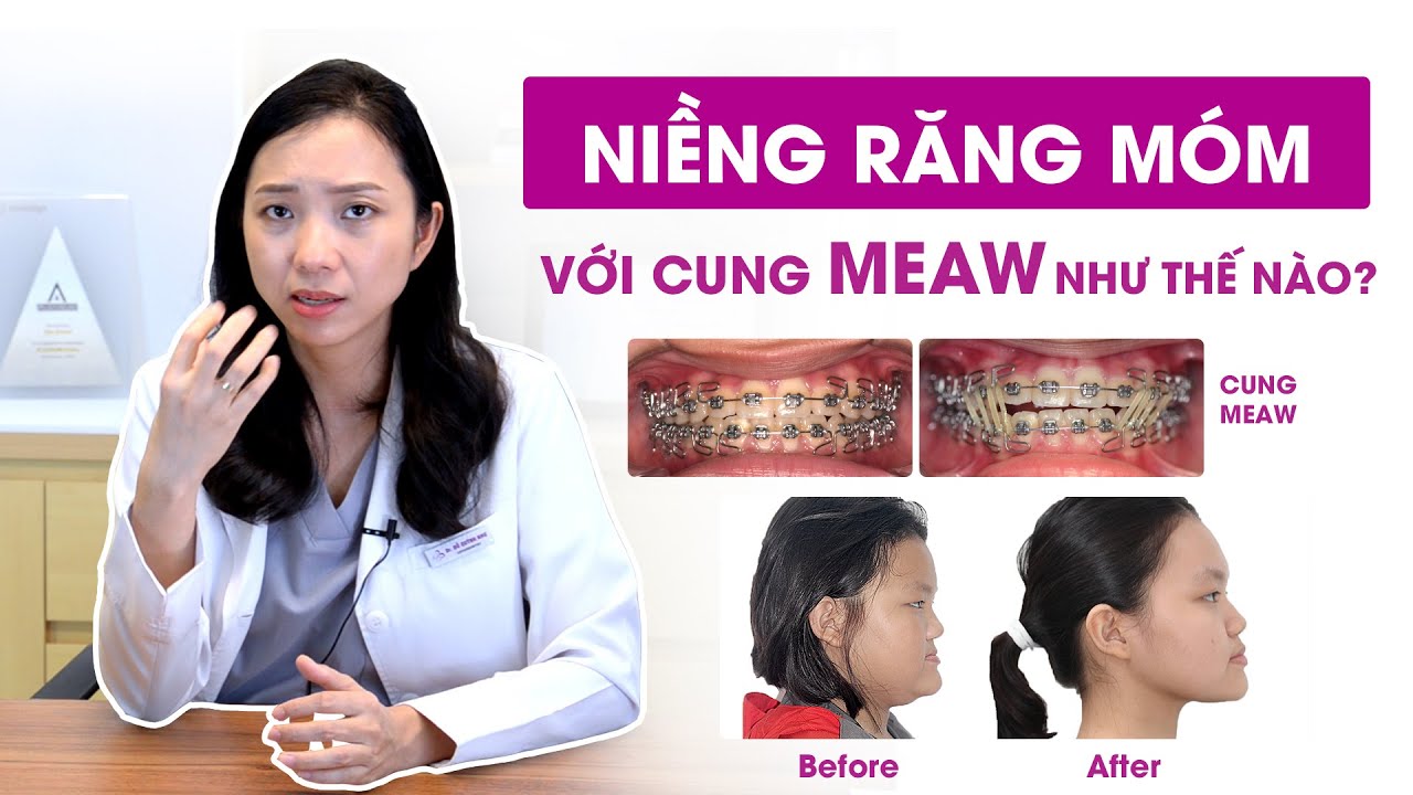 niềng răng móm có hết không