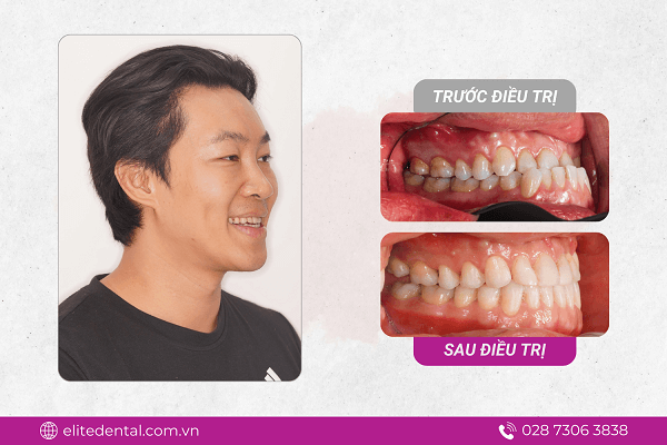 hình ảnh niềng răng móm trước và sau
