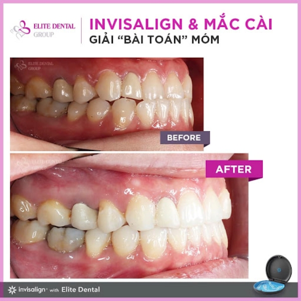 Răng của bệnh nhân trước và sau khi niềng