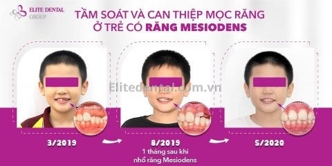 răng Mesiodens và những lưu ý tầm soát thay răng cho trẻ 3