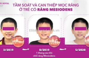 răng Mesiodens và những lưu ý tầm soát thay răng cho trẻ thumbnaill
