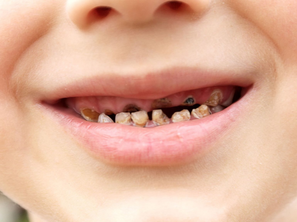 Tình trạng sâu răng ở trẻ 