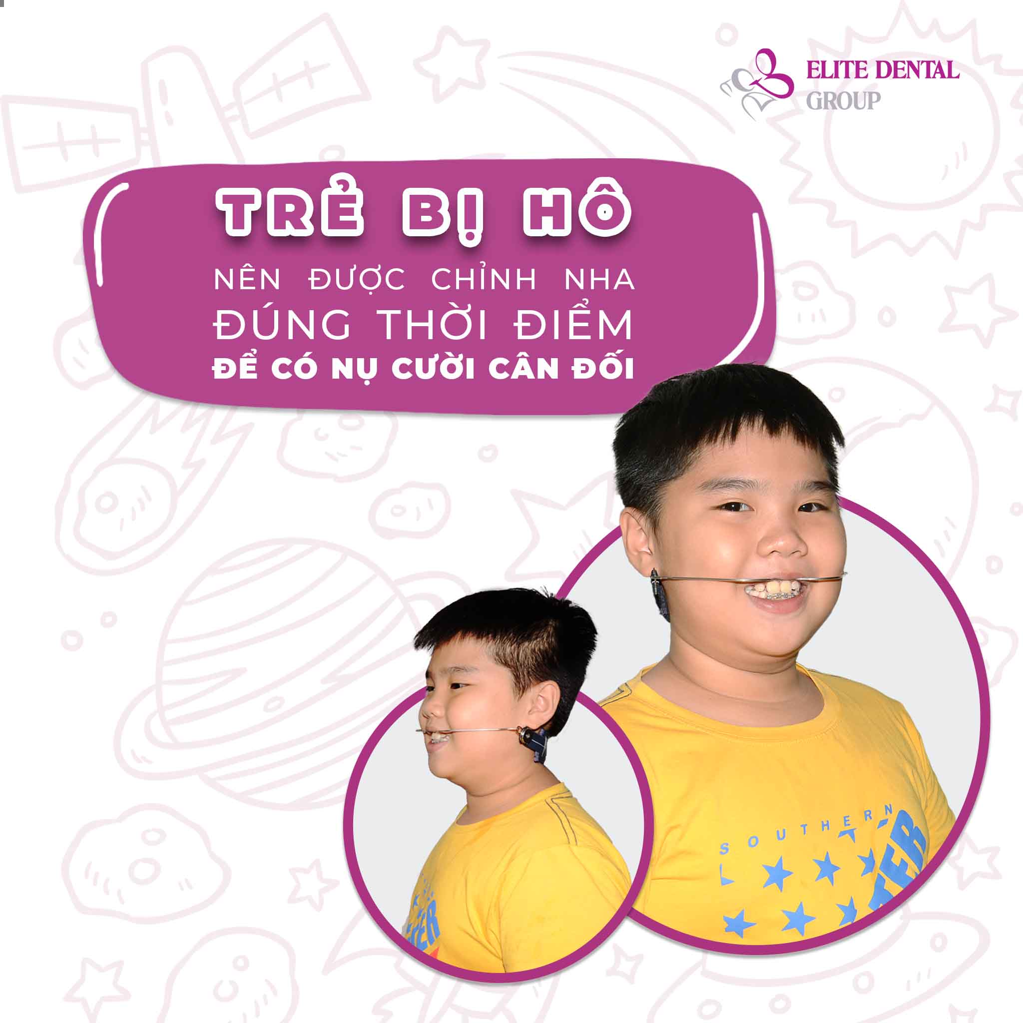 trẻ bị hô xương hàm thumbnail