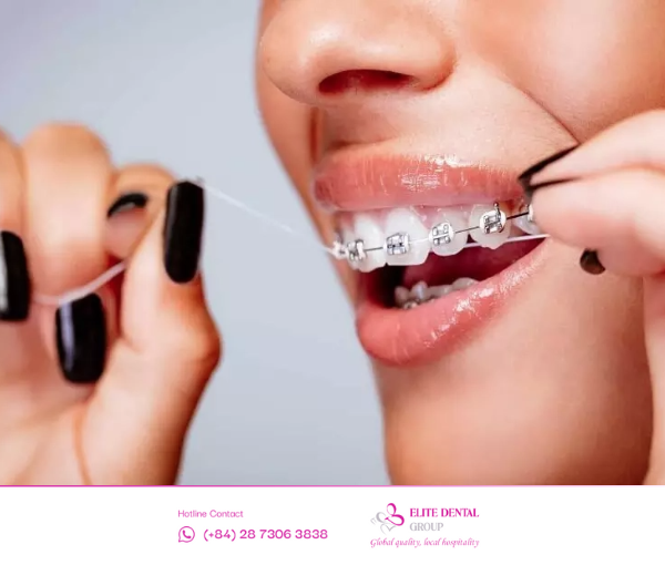 Chăm sóc răng cẩn thận khi niềng giúp răng chắc khỏe, mang lại hiệu quả chỉnh nha cao.