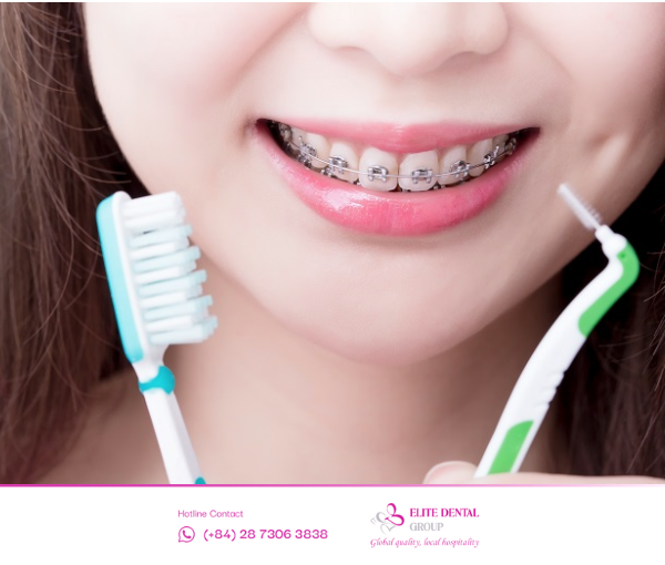 Vệ sinh răng niềng đúng cách giúp ngăn ngừa sâu răng và đảm bảo hành trình chỉnh nha diễn ra thuận lợi.