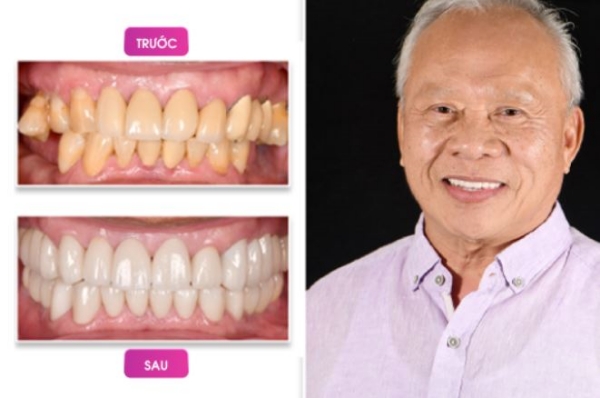Hình ảnh trước và sau khi trồng Implant của chú Tom Quách