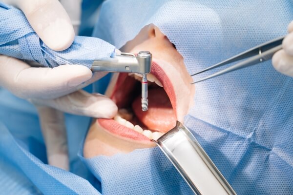 Có nên trồng răng Implant không?