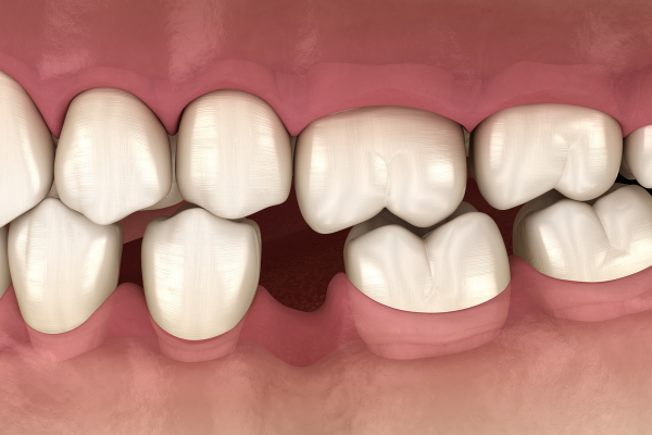 hậu quả khi để mất răng lâu năm