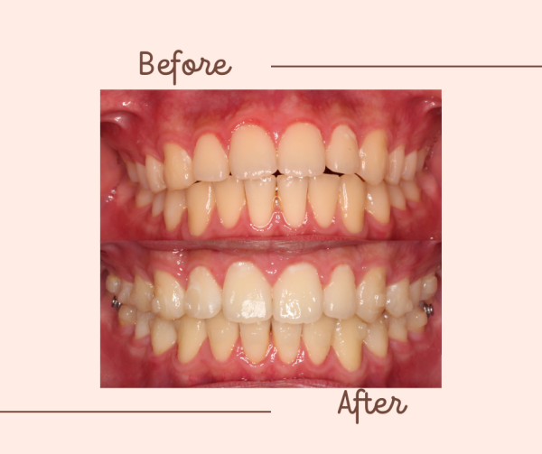 Kết quả niềng răng của bạn H.A - Hình 2