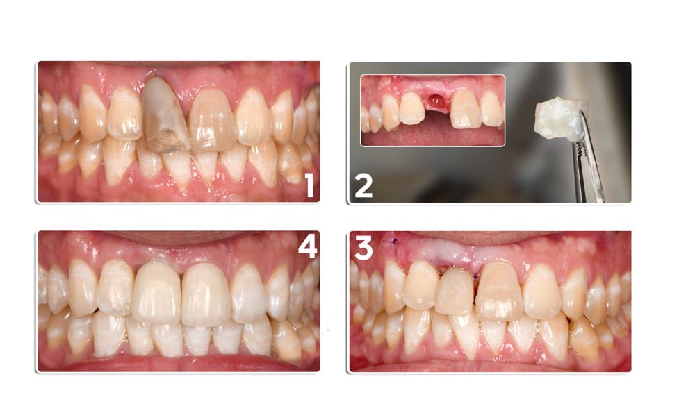 Kết quả phục hồi việc mất răng cửa tại Elite Dental