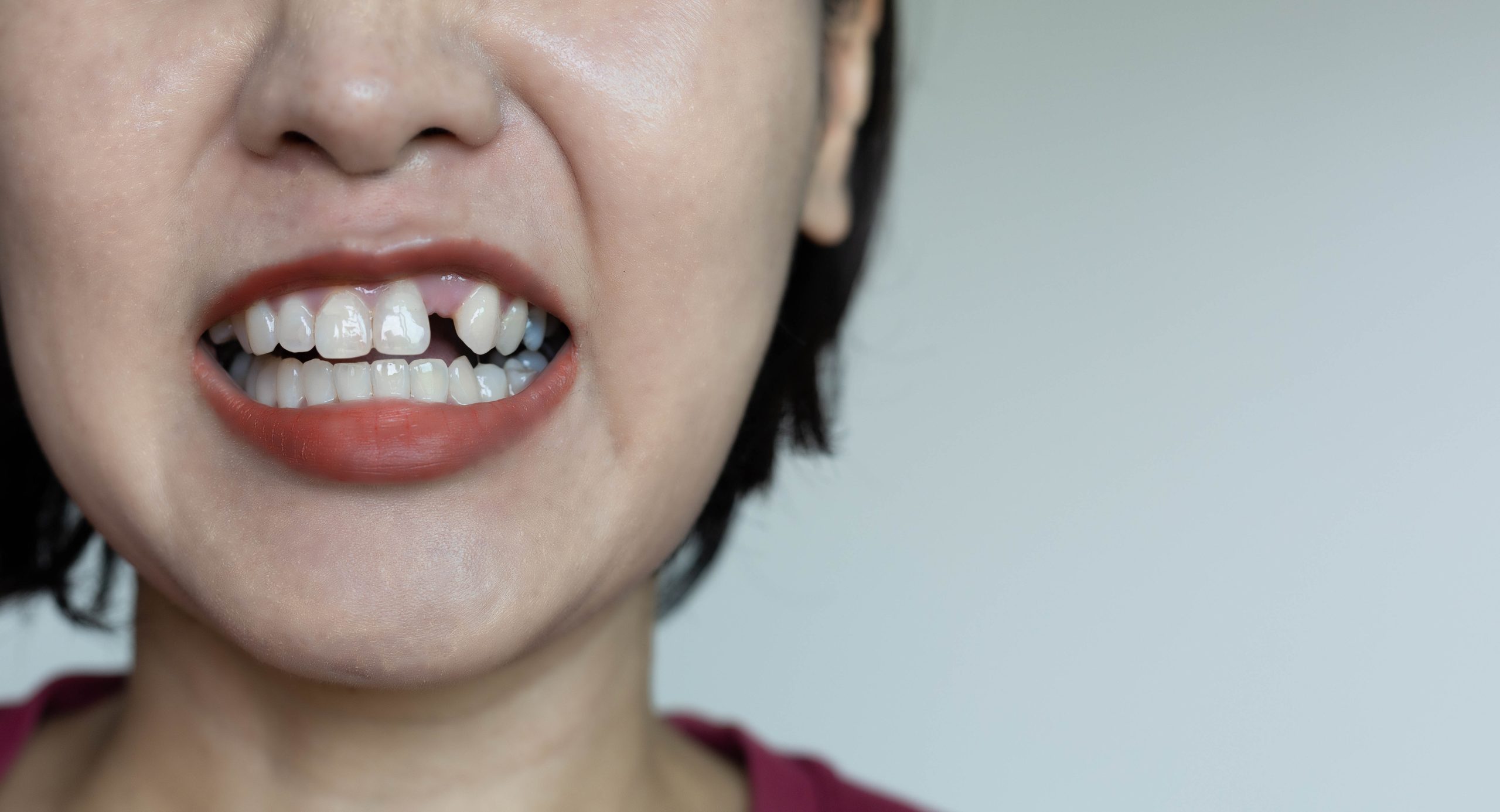 Mất răng khiến nhiều người tự tin khi giao tiếp