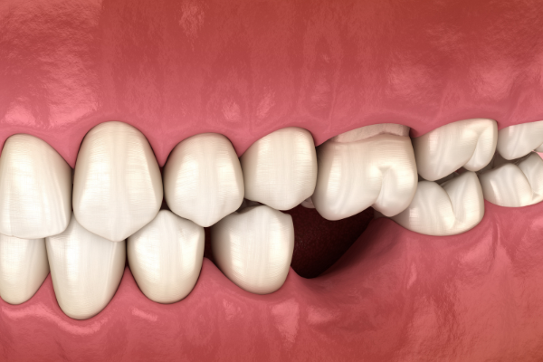  Khoảng hở rụng răng tác động xấu lên hàm và nướu 