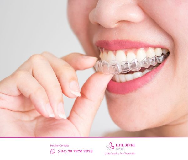 Niềng răng trong suốt Invisalign đang trở thành xu hướng thẩm mỹ hiện nay