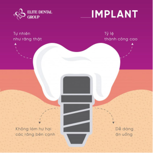hình ảnh mô tả phương pháp trồng răng implant
