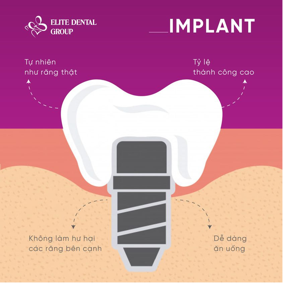 hình ảnh mô tả phương pháp trồng răng implant