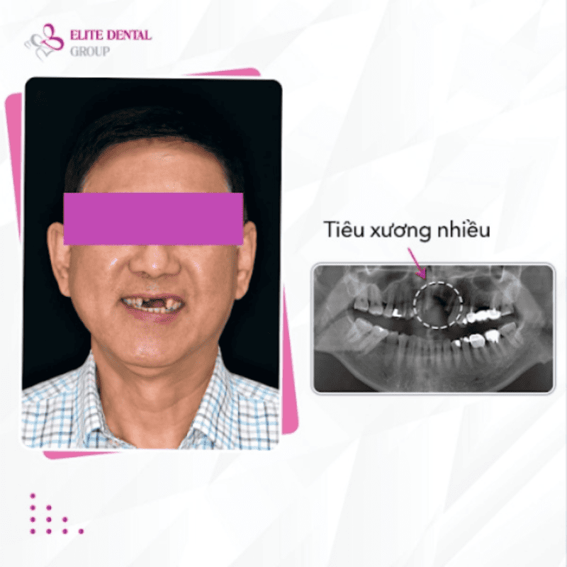 Tại sao nên trồng răng giả cố định