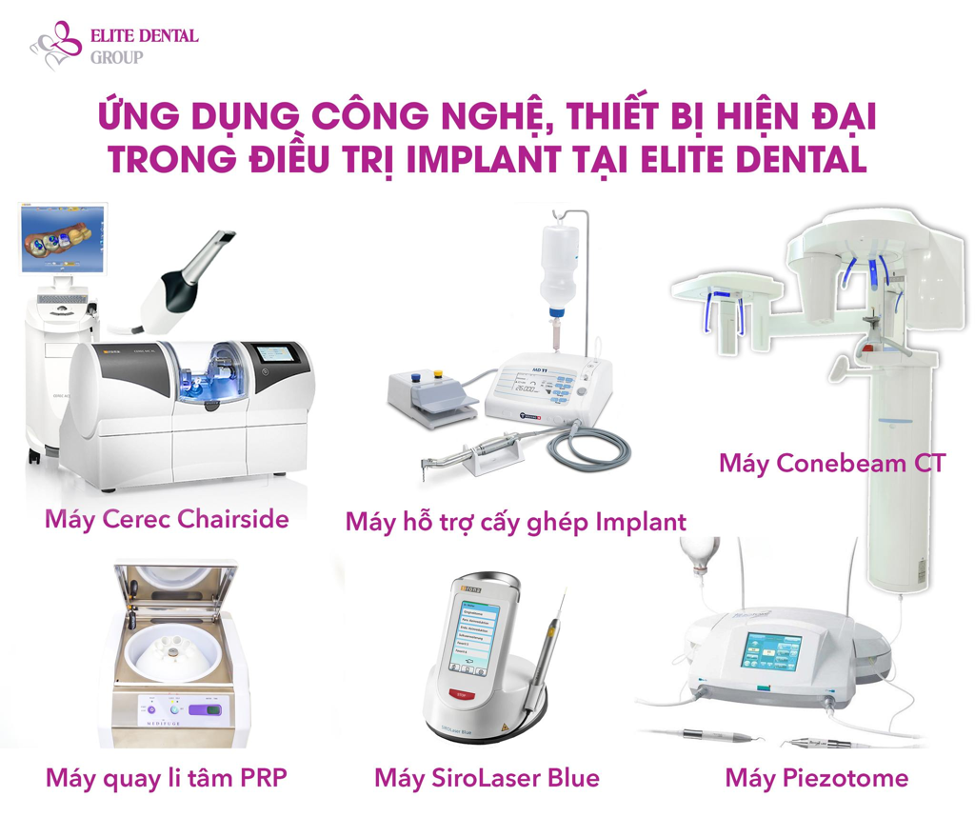Ứng dụng công nghệ hiện tại khi cấy ghép Implant tại Elite Dental