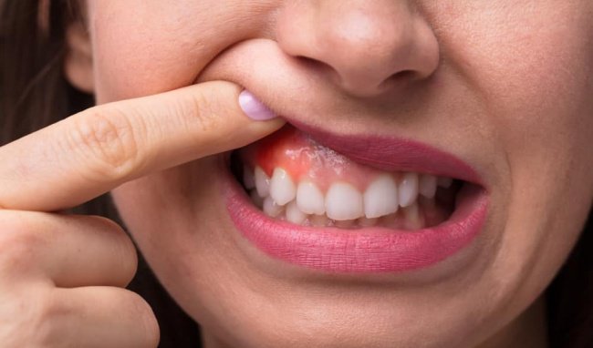 Dấu hiệu sưng nướu răng