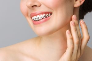Giá niềng răng mắc cài