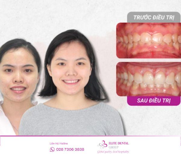 Trước và sau niềng răng