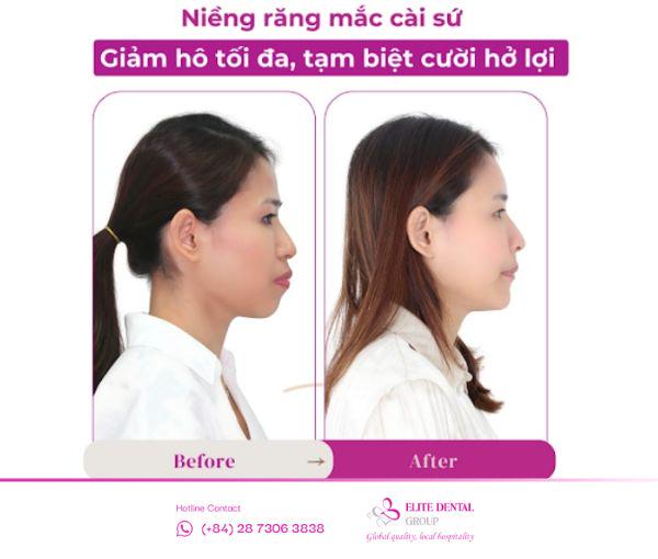 Trước và sau niềng răng mắc cài sứ