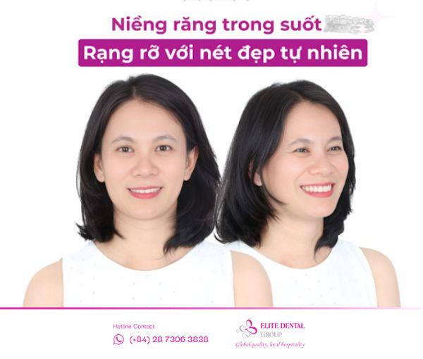 Niềng răng trong suốt