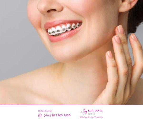 Niềng răng có trả góp không? Có, dịch vụ này cho phép khách hàng chia nhỏ số tiền dịch vụ và thanh toán nhiều đợt khác nhau.