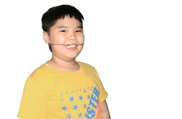Niềng răng trẻ em với khí cụ tháo lắp