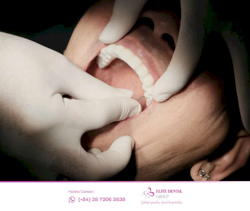 Đặt trụ Implant tức thì khi nhổ giúp rút ngắn quy trình và gắn răng tạm sau 24-48 giờ để đảm bảo ăn nhai thẩm mỹ