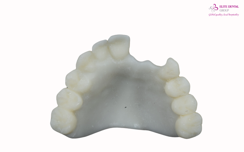 Xác định vị trí Implant phù hợp và chính xác