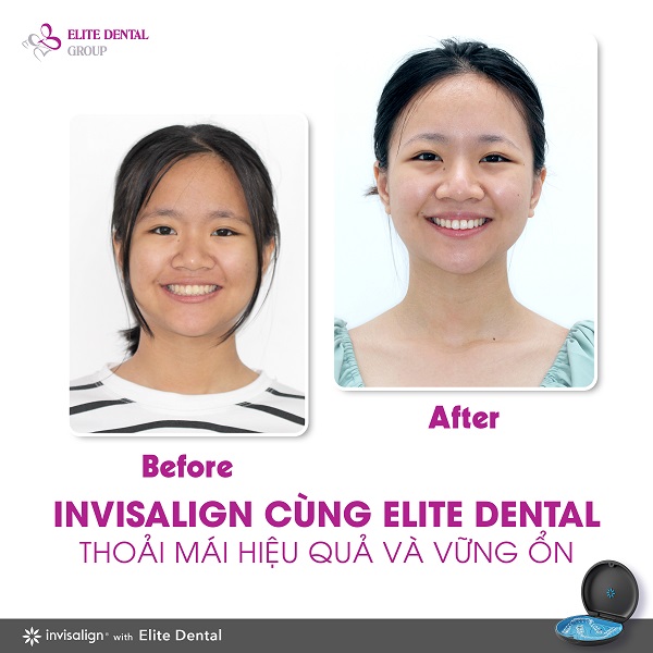 Hình ảnh bạn Mai Xinh trước và sau khi niềng răng