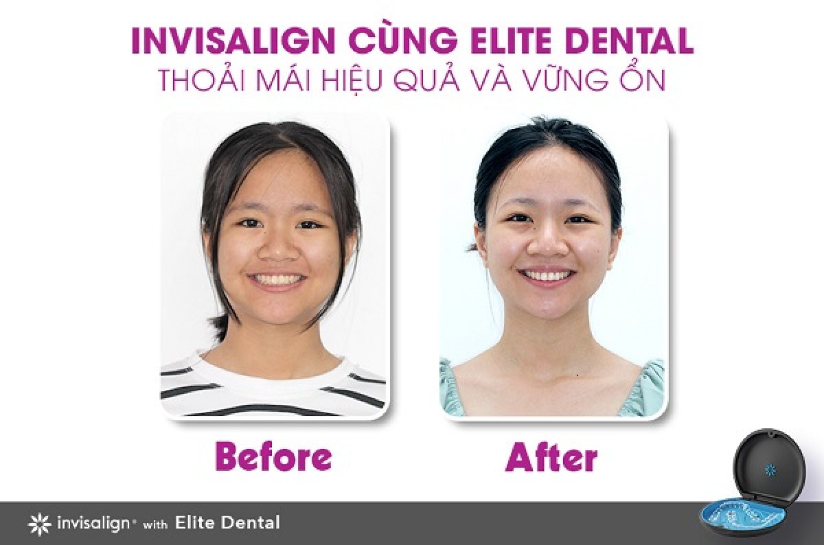 Câu chuyện khách hàng | Elite Dental
