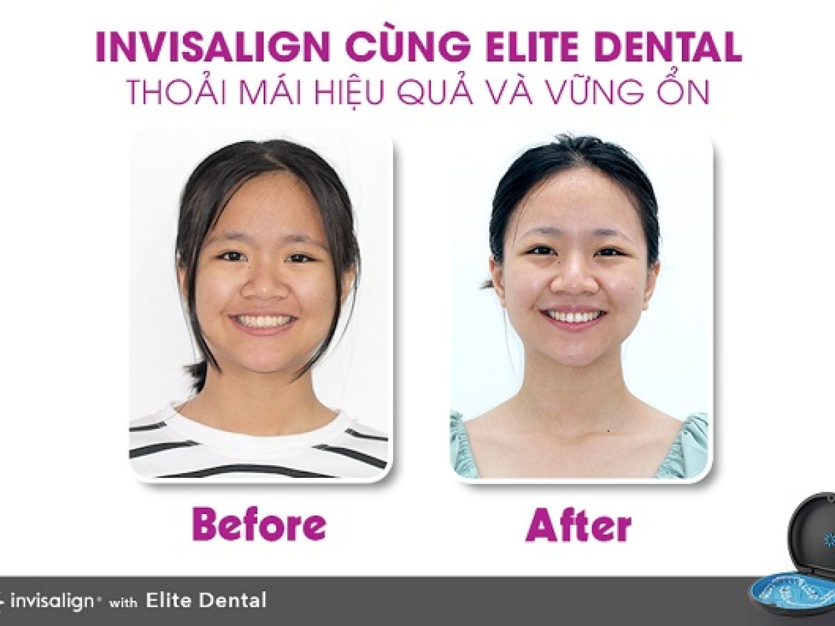 Câu chuyện khách hàng | Elite Dental