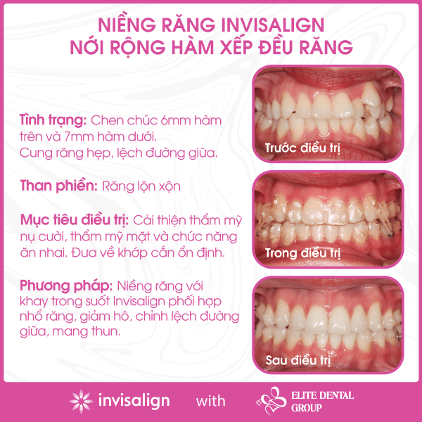 Niềng răng Invisalign nới rộng hàm xếp đều răng