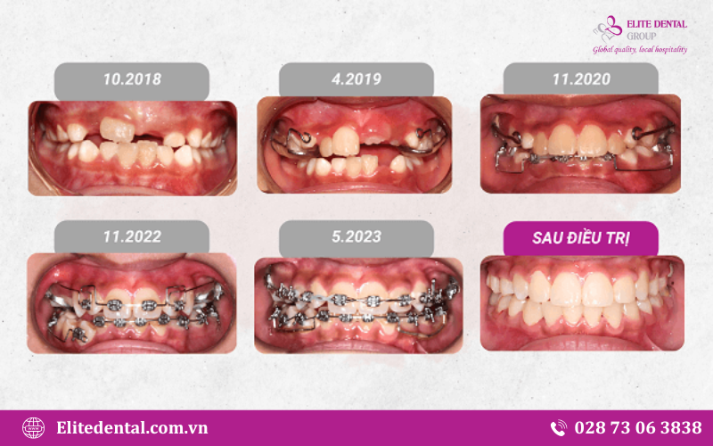Sự thay đổi về vị trí của răng trong quá trình chỉnh nha