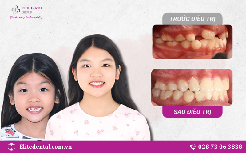 Tại Elite, mỗi phác đồ đều được xây dựng với mục tiêu đảm bảo hiệu quả điều trị vững chắc theo thời gian
