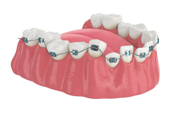 Lợi ích khi bọc răng sứ sau niềng răng là gì?
