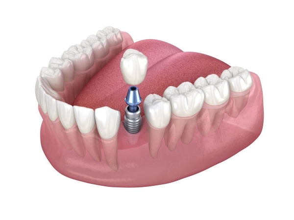 trồng răng implant có niềng răng được không